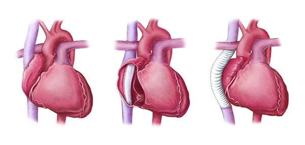 Emma Scheltema Illustration - Fontan Procedure published in EMJ Cardiology