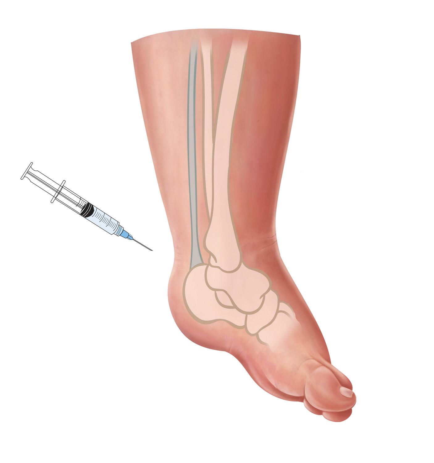 Emma Scheltema Illustration Clubfoot Tenotomy for Starship Child Health