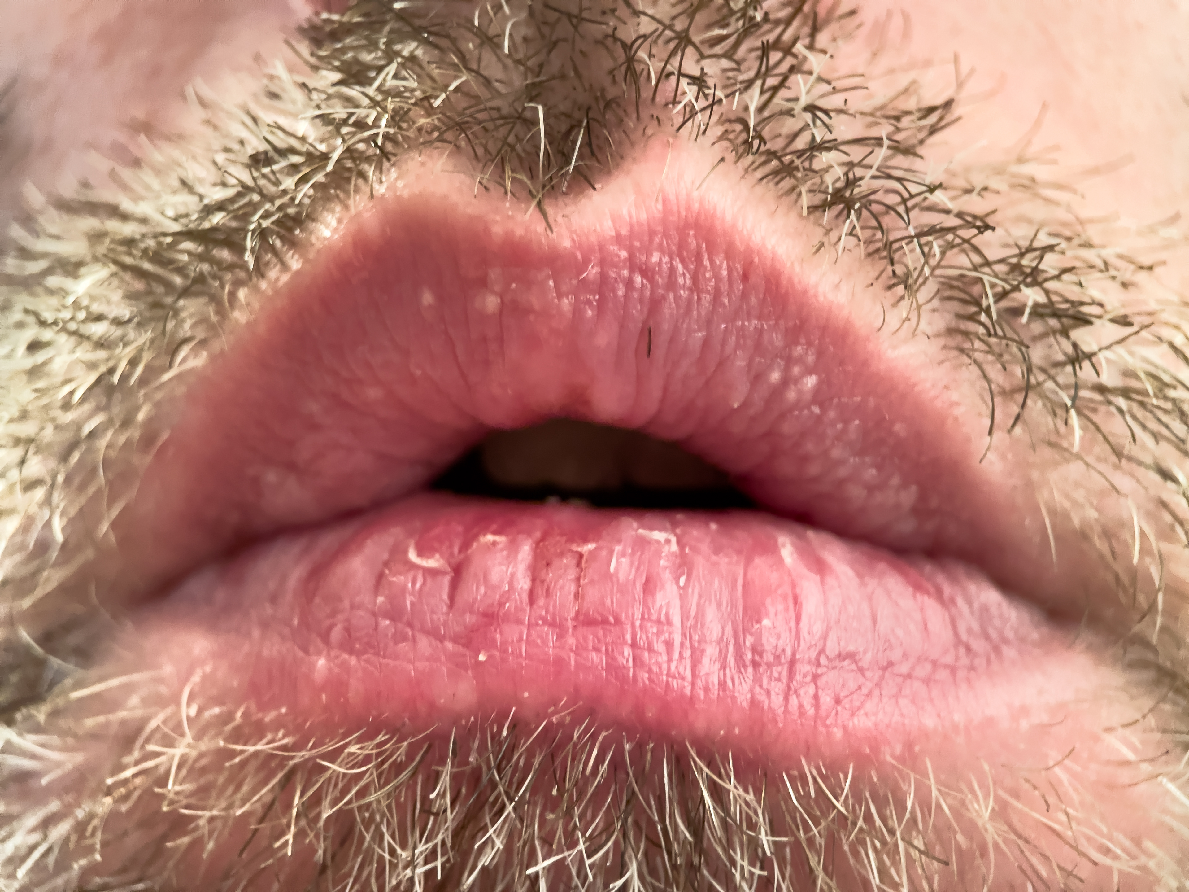 Unhappy lips from not drinking or eating anything for years.