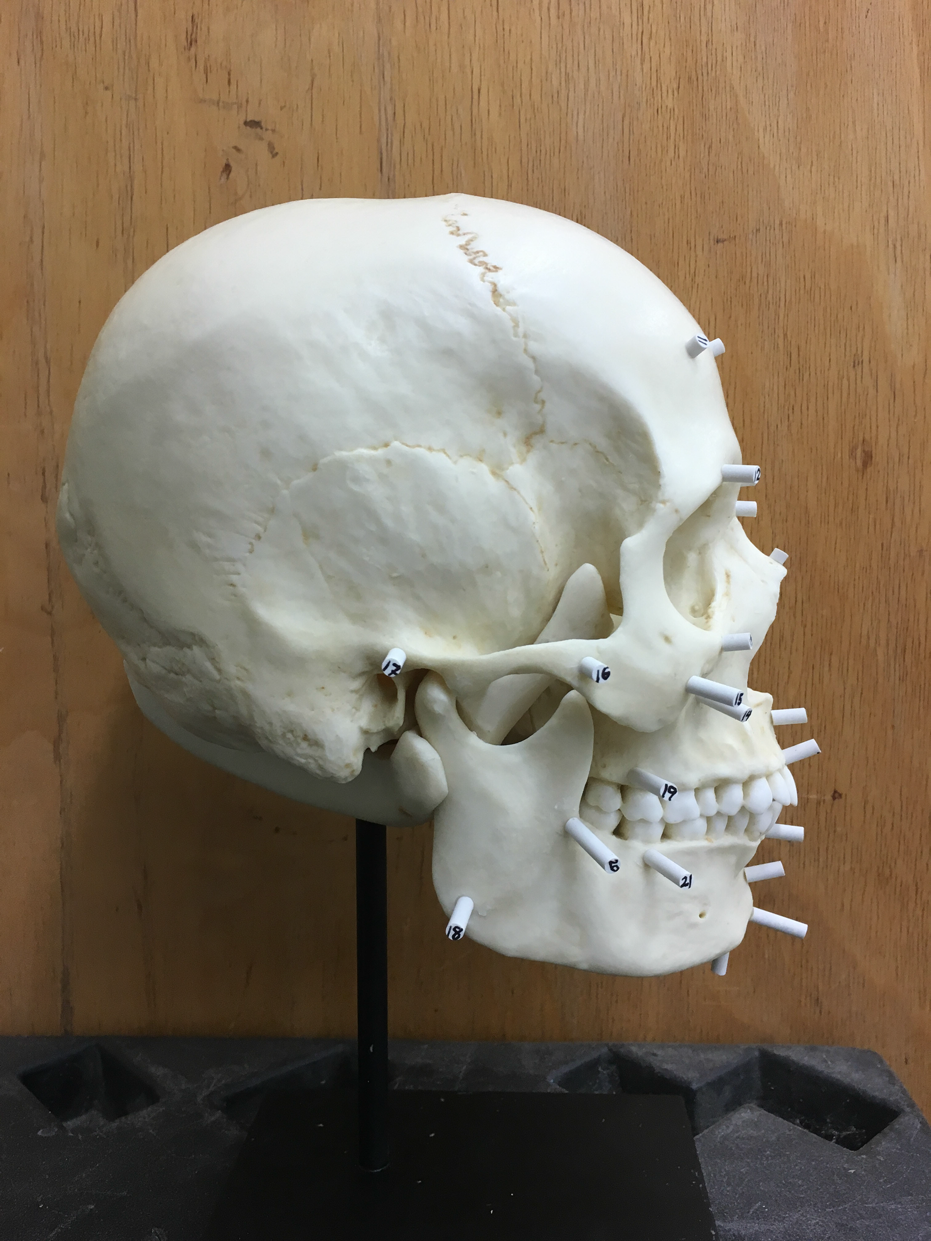 Lateral view of skull with tissue depth markers