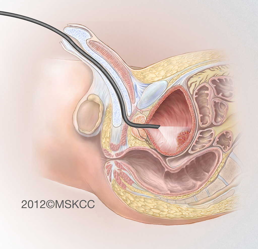 cystoscopy